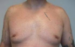 Male Breast Reduction Case 3 After