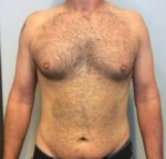 Male Breast Reduction Case 4 Before