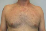 Male Breast Reduction Case 4 After