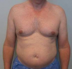 Male Breast Reduction Case 5 Before
