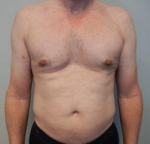 Male Breast Reduction Case 5 After