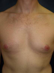 Male Breast Reduction Case 1 Before