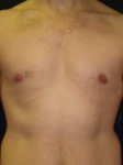 Male Breast Reduction Case 1 After