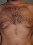 Male Breast Reduction Case 2 Before