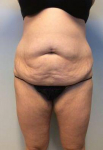 Abdominoplasty Case 11 Before
