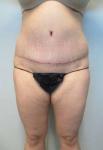 Abdominoplasty Case 11 After