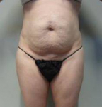 Abdominoplasty Case 15 Before