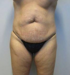 Abdominoplasty Case 17 Before