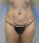 Abdominoplasty Case 18 Before