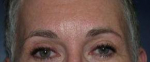 Brow Lift Case 2 After