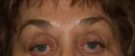 Brow Lift Case 3 After