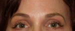 Brow Lift Case 1 After