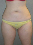 Liposuction Case 2 After