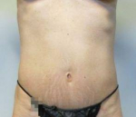Abdominoplasty Case 23 After