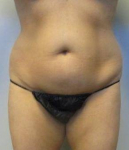 Abdominoplasty Case 26 Before