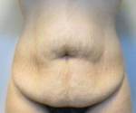 Abdominoplasty Case 27 Before