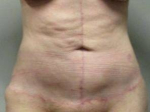 Abdominoplasty Case 28 After