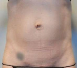 Abdominoplasty Case 30 Before