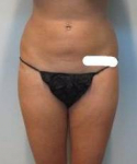 Liposuction Case 4 After