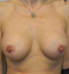Breast Augmentation Case 10 After