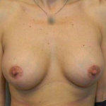 Breast Augmentation Case 10 After