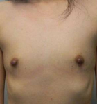 Breast Augmentation Case 11 Before