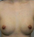 Breast Augmentation Case 11 After