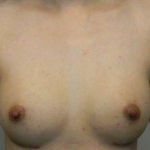 Breast Augmentation Case 11 After