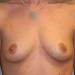 Breast Augmentation Case 12 Before
