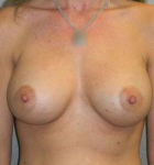 Breast Augmentation Case 12 After