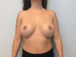 Breast Augmentation Case 14 After