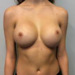 Breast Augmentation Case 15 After