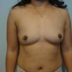 Breast Augmentation Case 16 Before