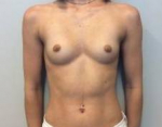 Breast Augmentation Case 17 Before