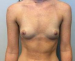 Breast Augmentation Case 18 Before