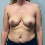 Breast Augmentation Case 20 Before