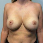 Breast Augmentation Case 20 After