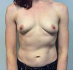 Breast Augmentation Case 21 Before