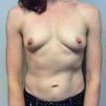 Breast Augmentation Case 21 Before