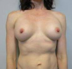 Breast Augmentation Case 21 After