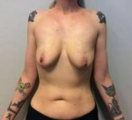 Breast Augmentation Case 22 Before