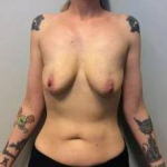 Breast Augmentation Case 22 Before