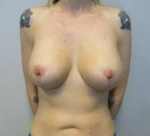 Breast Augmentation Case 22 After