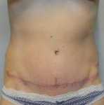 Abdominoplasty Case 1 After
