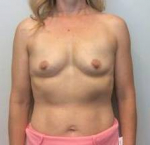 Breast Augmentation Case 23 Before