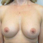 Breast Augmentation Case 23 After