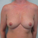 Breast Augmentation Case 24 Before