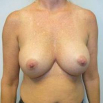 Breast Augmentation Case 24 After