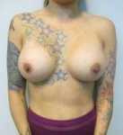 Breast Augmentation Case 25 After