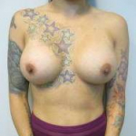 Breast Augmentation Case 25 After